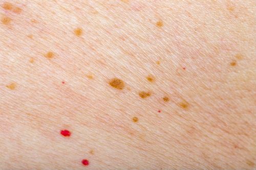 tips-to-prevent-red-moles-on-your-body