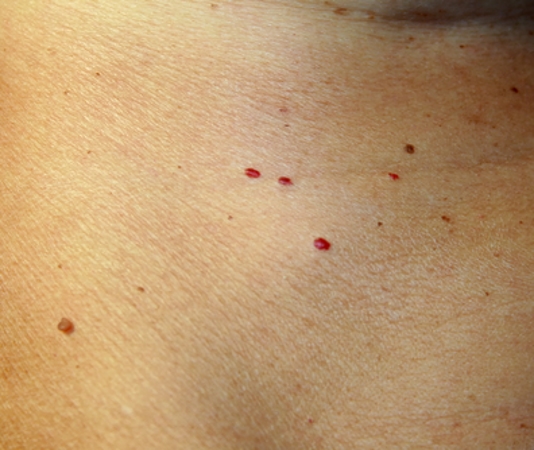 Blogs: Cherry Angioma Removal | Skin Deep Laser Services