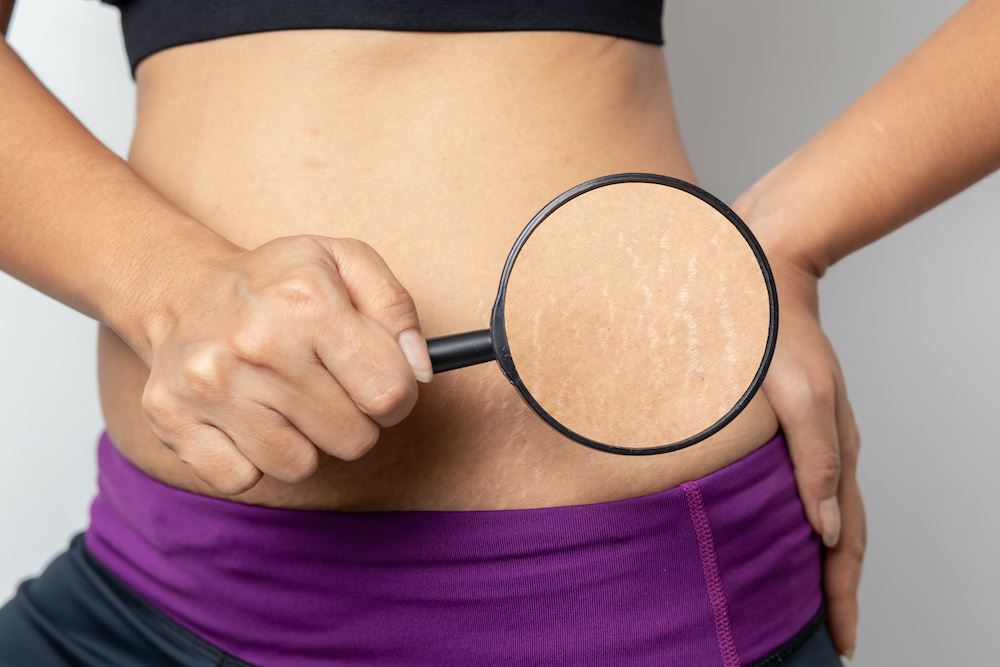 get-rid-of-unwanted-stretch-marks-effectively-with-a-virtuerf-treatment