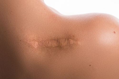 Are Lasers or Surgery Best for Scar Revision?