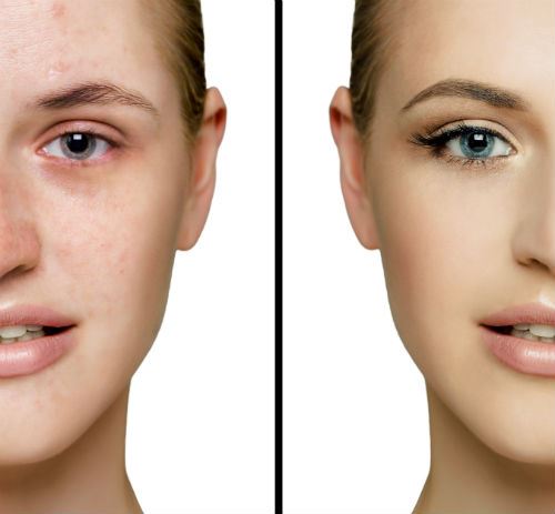 Are You A Good Candidate For Laser Skin Resurfacing?